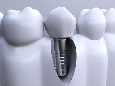 承德種植牙價格表，2024種植牙多少錢一顆呢?