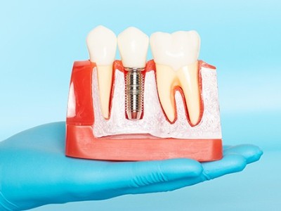 種牙VS鑲牙，你適合哪種?