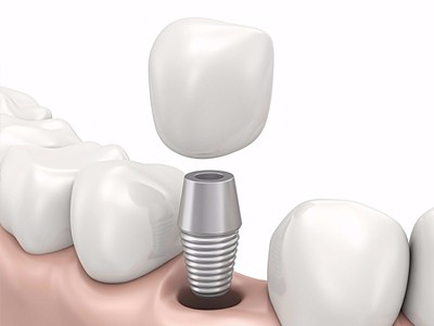 在承德哪家口腔醫(yī)院口腔種植齒好一點(diǎn)，惟德口腔醫(yī)院值得您的選擇