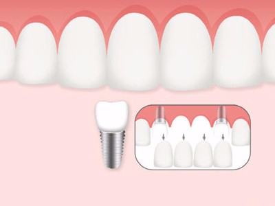 惟德口腔口腔種植怎么樣？惟德口腔就來為您一一解答