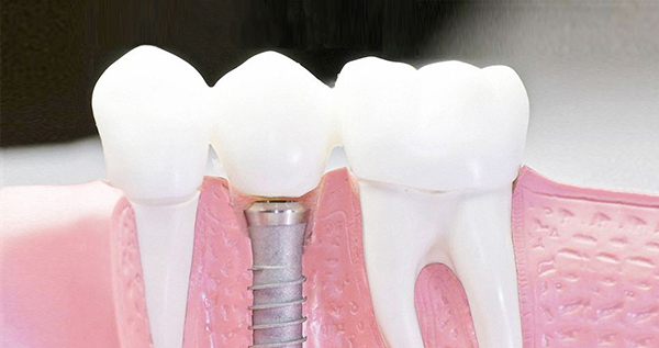在承德口腔種植牙齒需要多少錢？惟德口腔一一為您道來(lái)